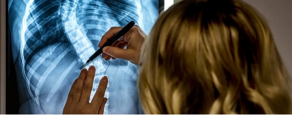 scoliosis