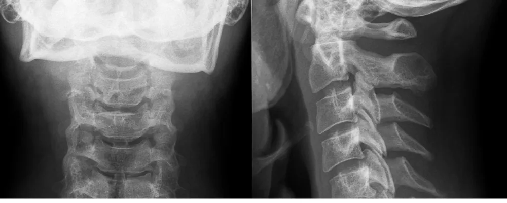 neck pain