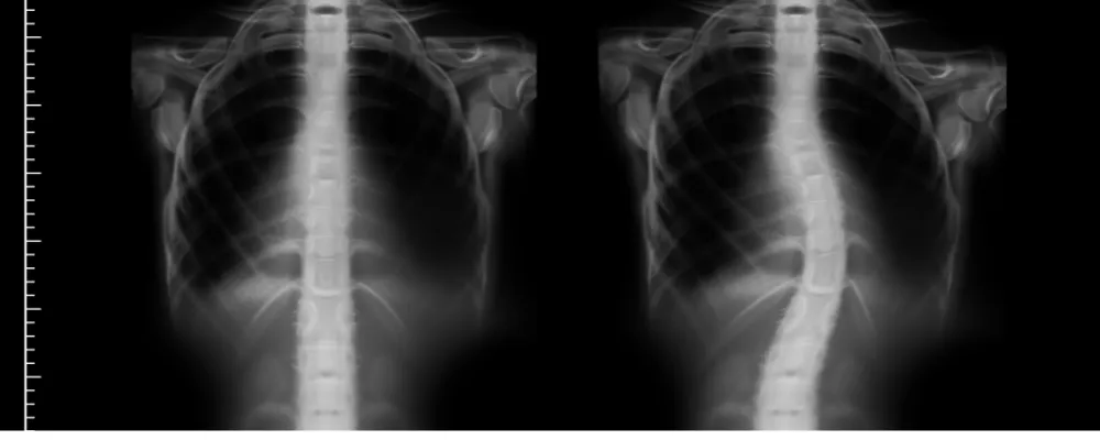 scoliosis